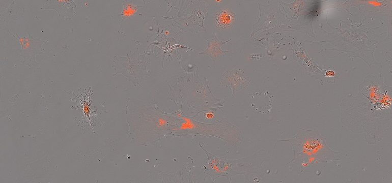 Artificially generated induced pluripotent stem cells (iPSCs) from somatic cells play an important role for disease modeling