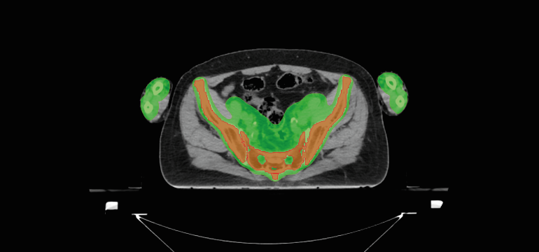 In order to optimize the radiotherapy delivery for cancer treatment, especially when dealing with complex treatments such as