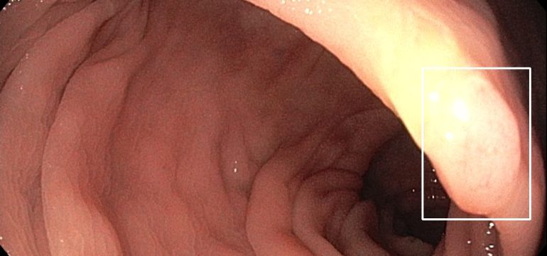 Detection and diagnosis of colon polyps are key to preventing colorectal cancer. Recent evidence suggests that AI-based compu