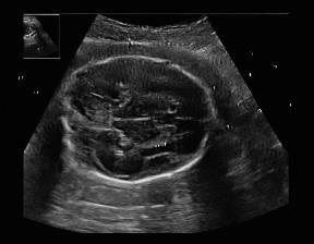 Obstetric ultrasound image quality is crucial for accurate diagnosis and monitoring of fetal health. However, producing high-