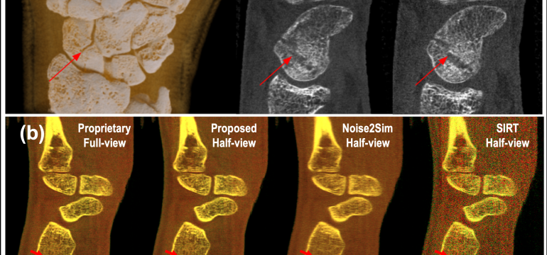 The latest X-ray photon-counting computed tomography (PCCT) for extremity allows multi-energy high-resolution (HR) imaging fo
