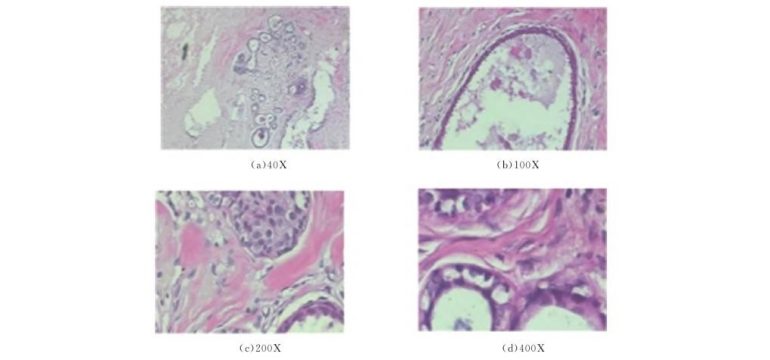 Breast cancer is a relatively common cancer among gynecological cancers. Its diagnosis often relies on the pathology of cells