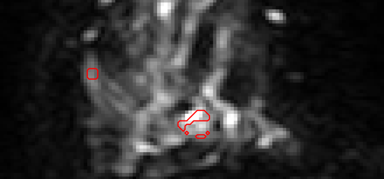 Effective surgical planning for breast cancer hinges on accurately predicting pathological complete response (pCR) to neoadju