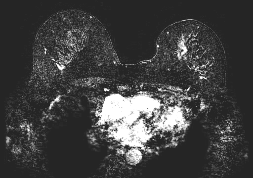 This paper presents a method for virtual contrast enhancement in breast MRI, offering a promising non-invasive alternative to