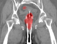 The precision of contouring target structures and organs-at-risk (OAR) in radiotherapy planning is crucial for ensuring treat