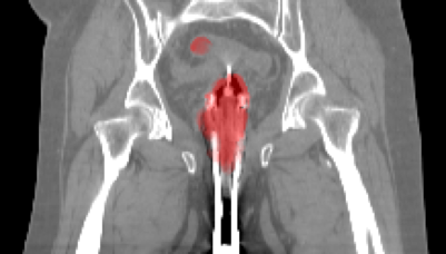 The precision of contouring target structures and organs-at-risk (OAR) in radiotherapy planning is crucial for ensuring treat