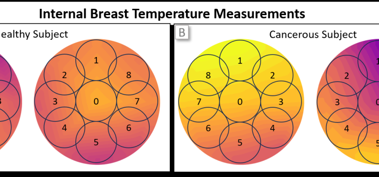 The pursuit of enhanced breast cancer detection and monitoring techniques is a paramount healthcare objective, driving the ne